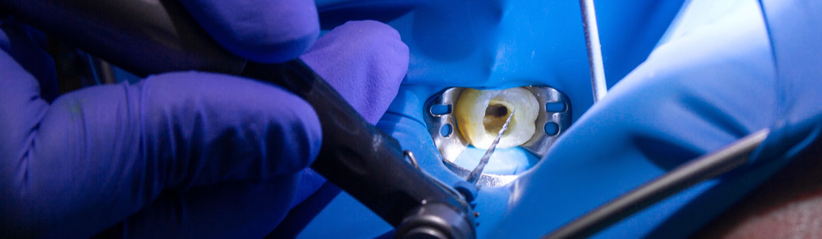 Endodontic therapy in Wrexham