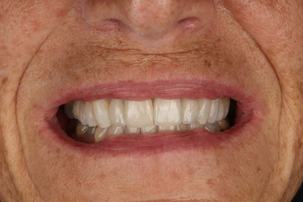 Woman after having porcelain veneers fitted