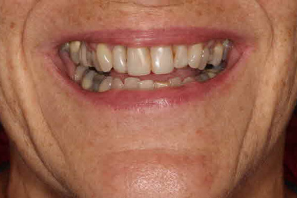 Woman before having porcelain veneers fitted