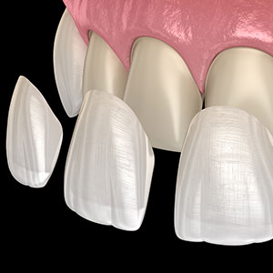 Graphic showing veneers attached to teeth