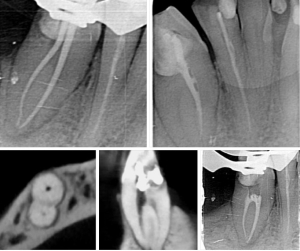 Capturing Endodontic Excellence